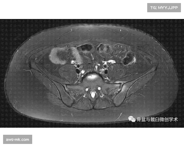 大连英博前锋马莱莱确诊慢性劳损性耻骨炎康复进展积极重返赛场可期